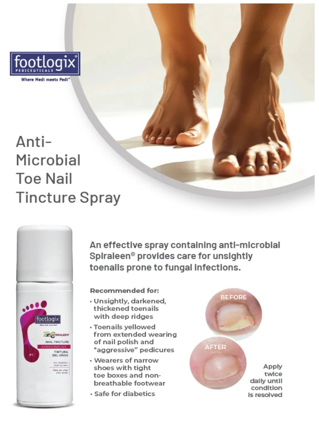 Footlogix Nail Tincture Spray - Grady’s Feet Essentials - Footlogix